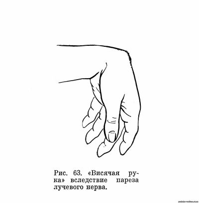 «висячая рука»