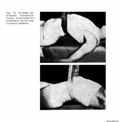 Техника репозиции компрессионных переломов тел позвонков