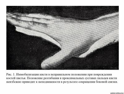Иммобилизация проксимальных суставов пальцев в положении разгибания