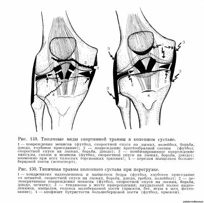 Типичные виды спортивной травмы в коленном суставе
