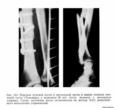 перелом диафиза лучевой кости с вывихом в дистальном лучелоктевом суст