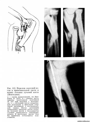 перелом диафиза локтевой кости с вывихом в проксимальном лучелоктевом