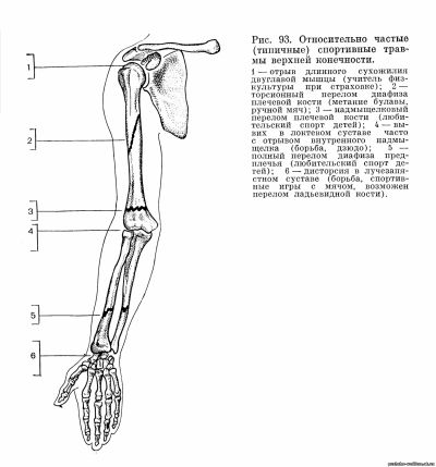 Относительно частые (типичные) спортивные травмы верхней конечности