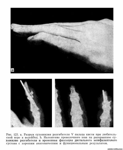 Разрыв сухожилия разгибателя V пальца кисти